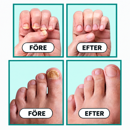 Zivex ClearNail™